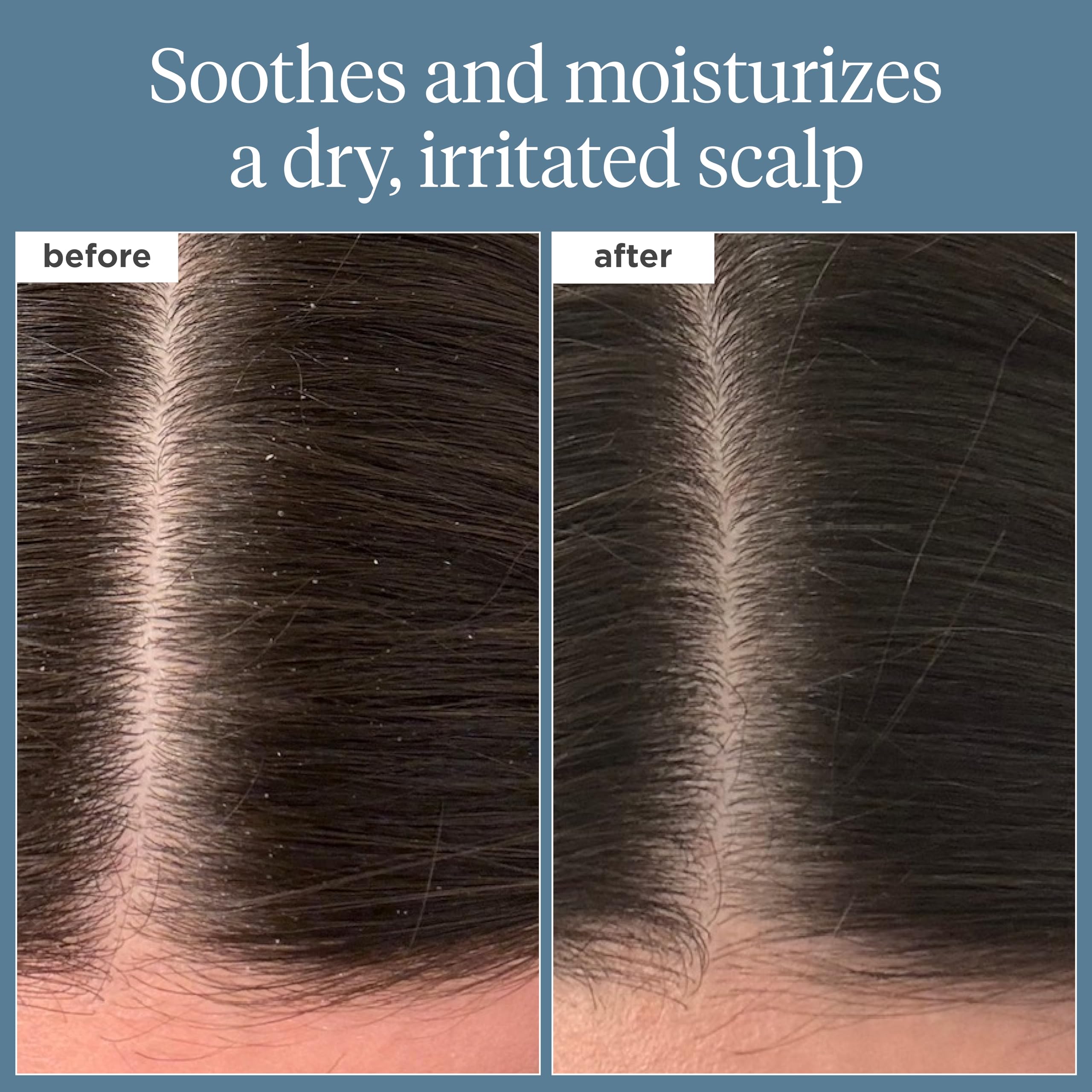 Briogeo Scalp Revival Rosemary Pre-Wash Oil, Hair and Scalp, Dry Scalp Treatment for Stronger and Longer Hair, Soothe Dry Scalp, Lipids and Vitamins, Deep Moisture, Vegan, Cruelty-Free, 3.4 fl oz